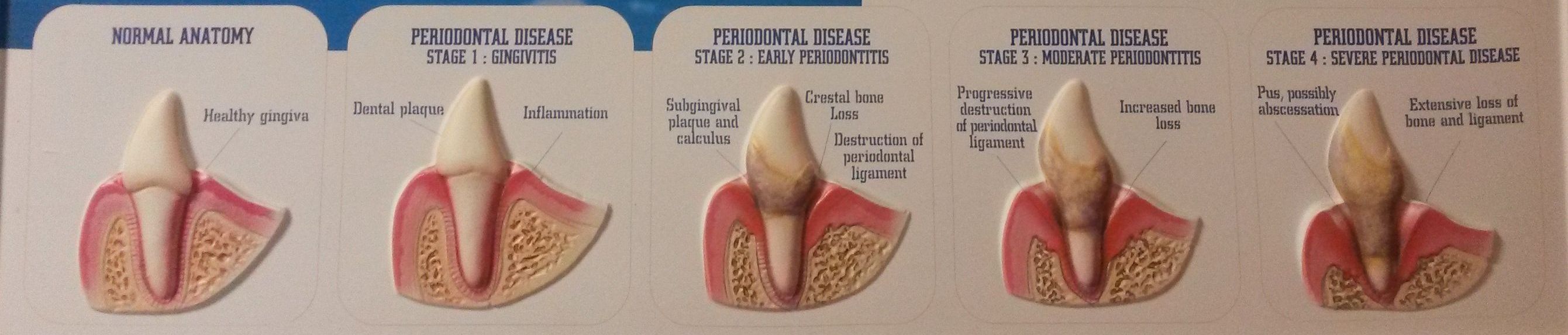 Onemocnění parodontu jen zuby